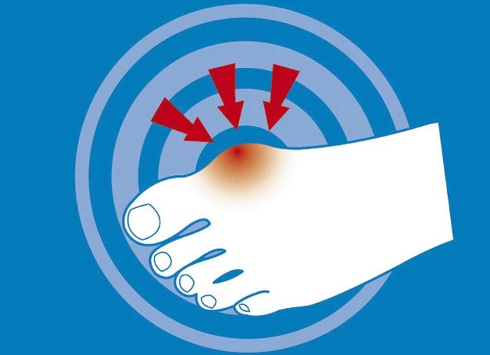 epitact Epithelium 26&reg; Hallux valgus-Schutz 